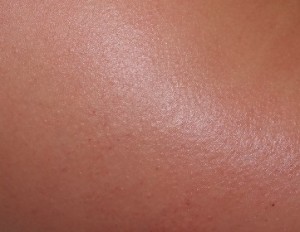 Skóra po zabiegu Skóra bezpośrednio po zabiegu