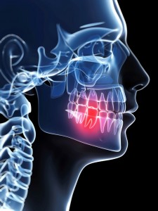 3d rendered illustration of a painful tooth