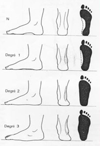 Płaskostopie (1)