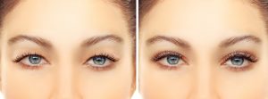 Asian Eyelid Surgery.Upper blepharoplasty.Correcting the aging process