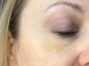 botox 1,5 tyg po zabiegu