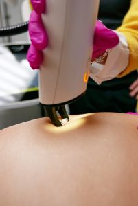 Laser FRAX - rozstępy_small